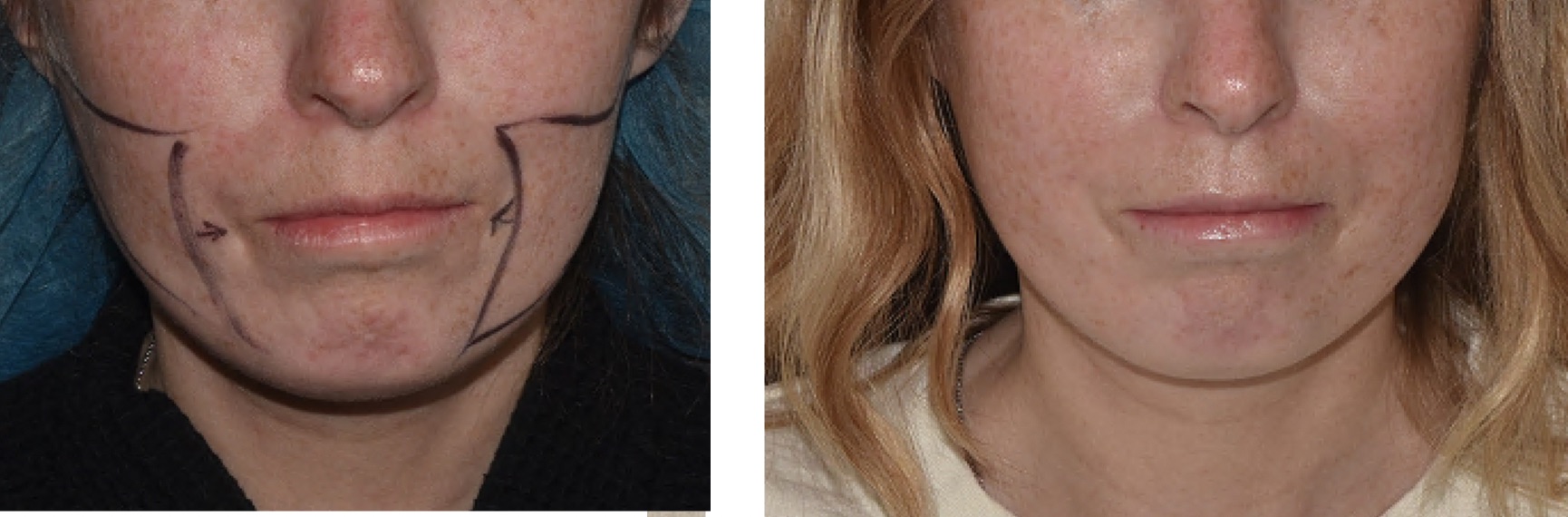 Before and after facial fat transfer, case 3.
