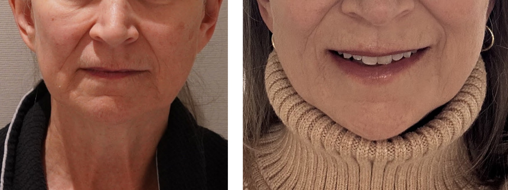 Before and after facial fat transfer, case 1.