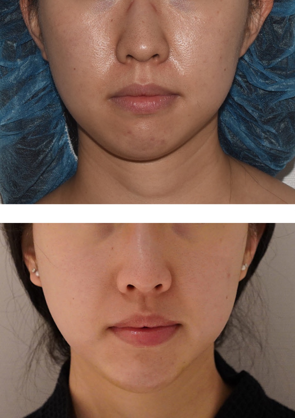 Before and after facial fat transfer, case 2.