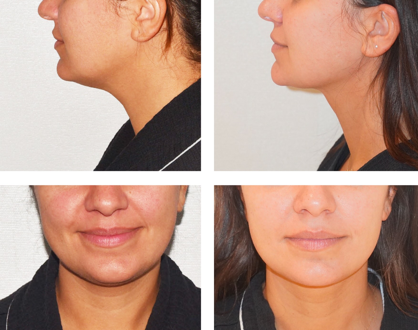 Before and after FaceTite and chin liposuction, case 2.