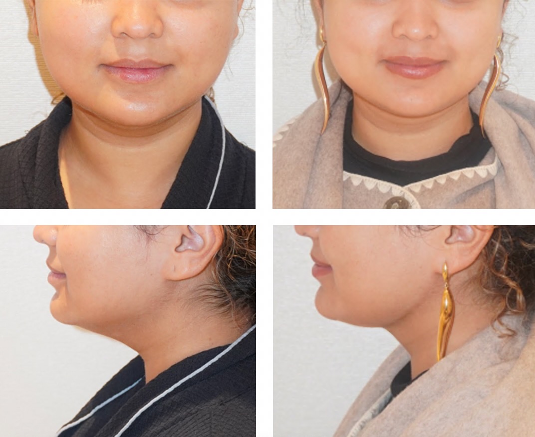 Before and after FaceTite and chin liposuction, case 3.