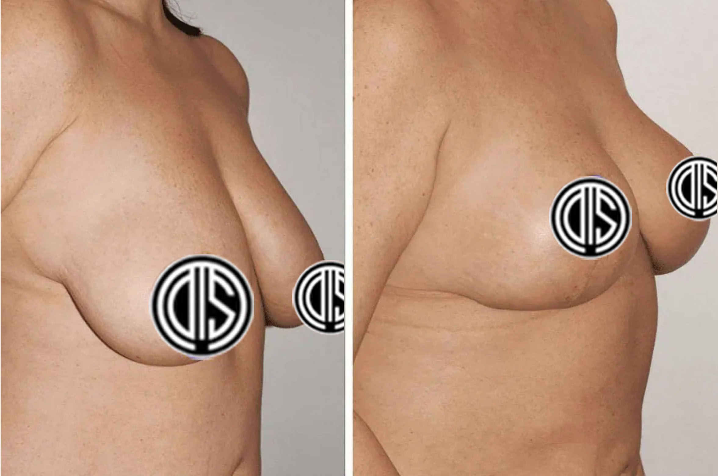 Before and after breast lift, case 3.