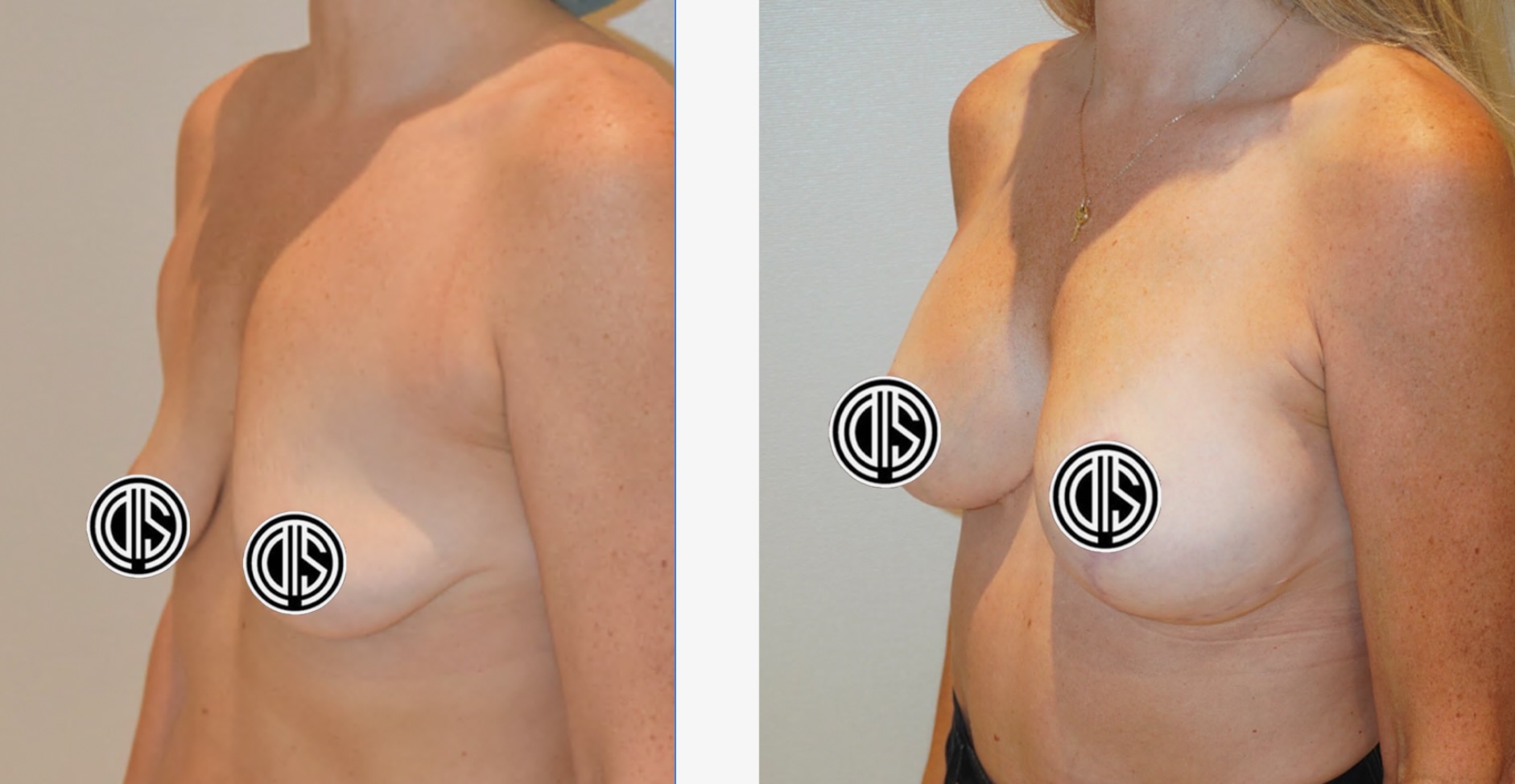Before and after breast lift, case 1.