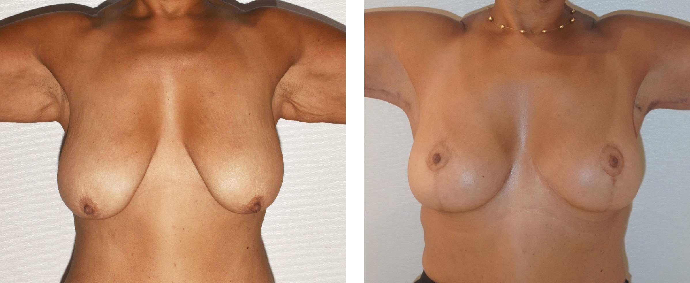 Before and after breast lift, case 2.