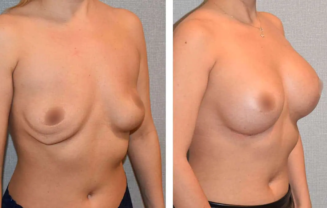 Before and after breast implant revision, case 1.