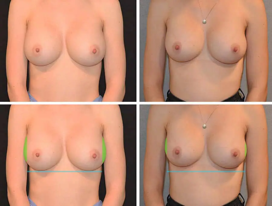 Before and after breast implant revision, case 3.