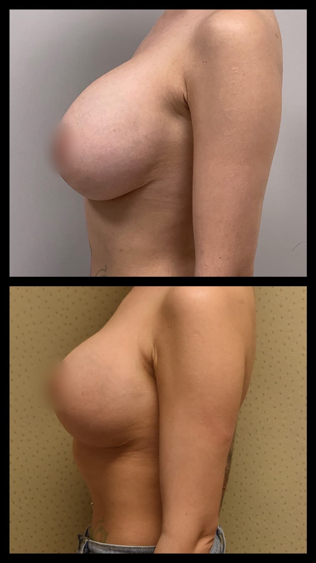 Before and after breast implant revision, case 2.