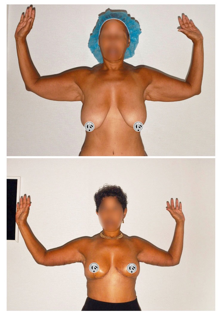 Before and after extended arm lift and breast reduction and lift with auto-augmentation following more than 100 pounds of GLP-1 weight loss. Her own breast tissue provided fullness without implants.
