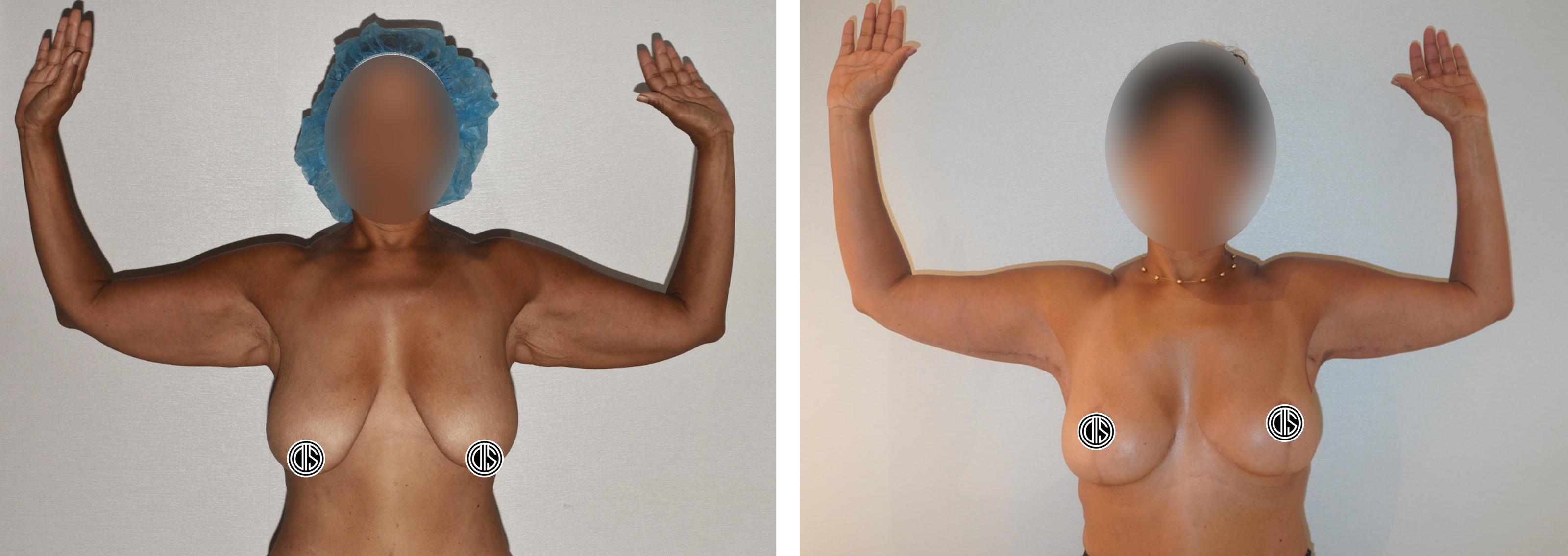 Before and after extended arm lift and breast reduction and lift with auto-augmentation following more than 100 pounds of GLP-1 weight loss. Her own breast tissue provided fullness without implants.