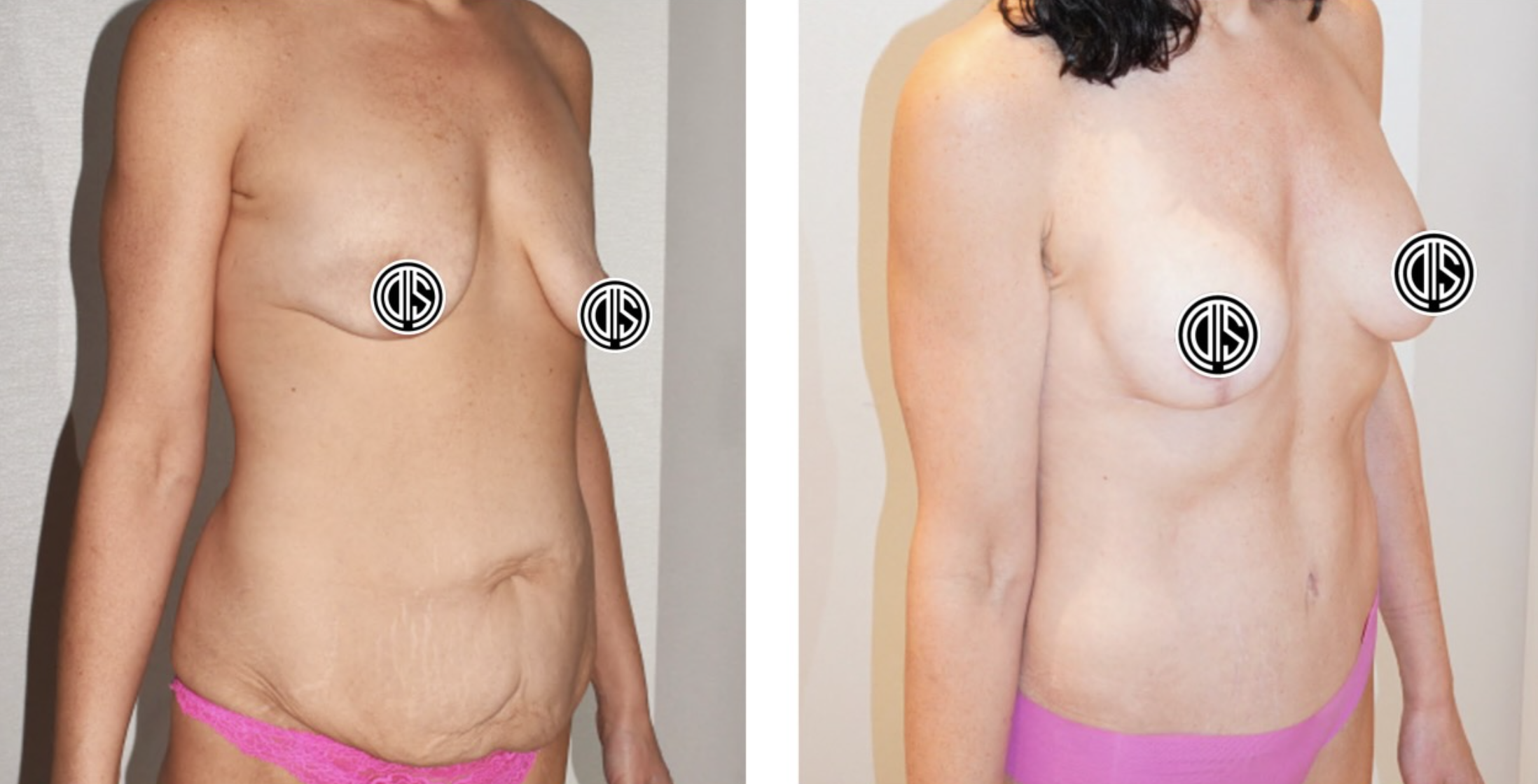 Before and 6 months after breast augmentation, breast lift and abdominoplasty. Individual results may vary.