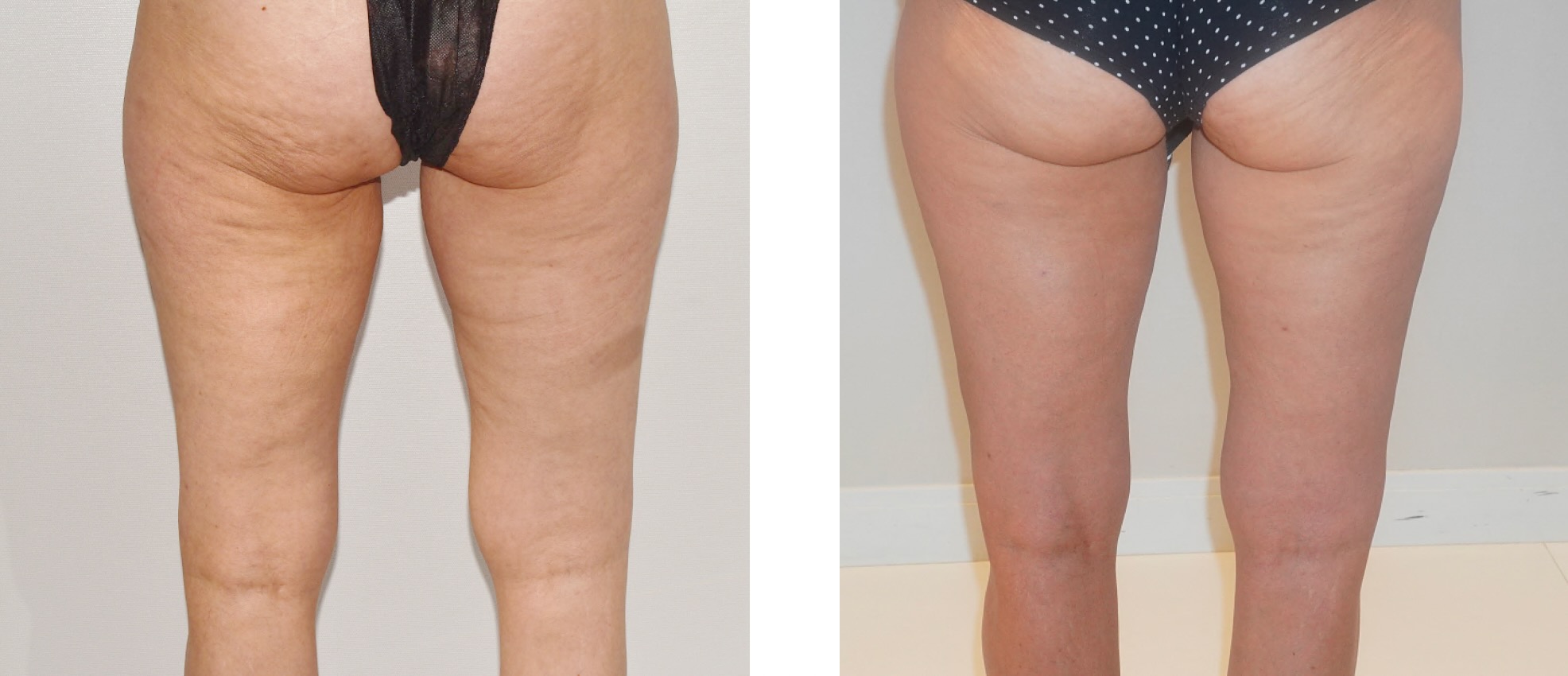 Leg liposuction photographs, Photo 103.
