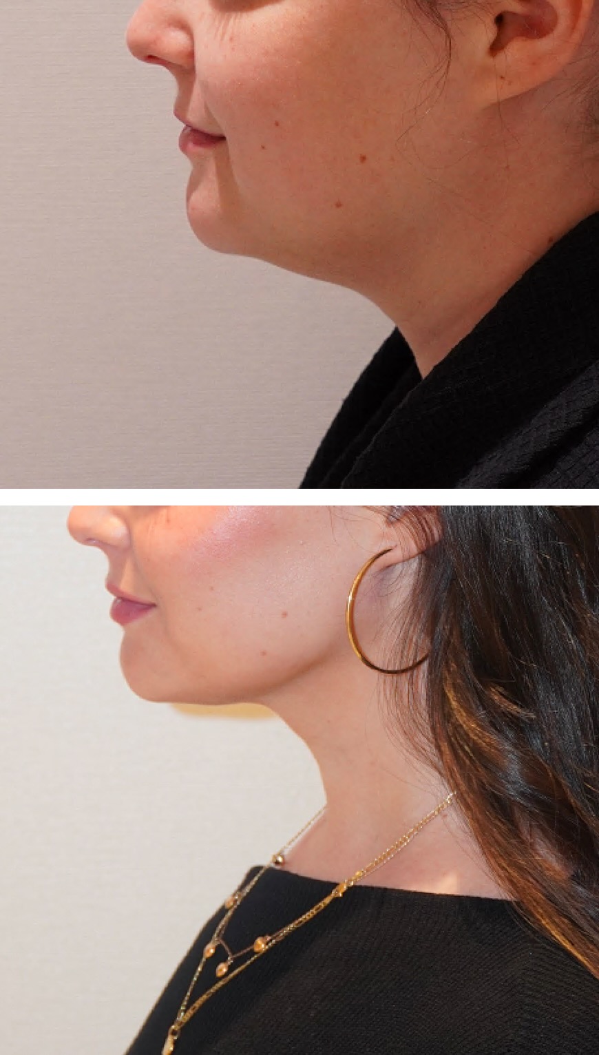 Before and after views of the chin and jawline following power-assisted liposuction and FaceTite.