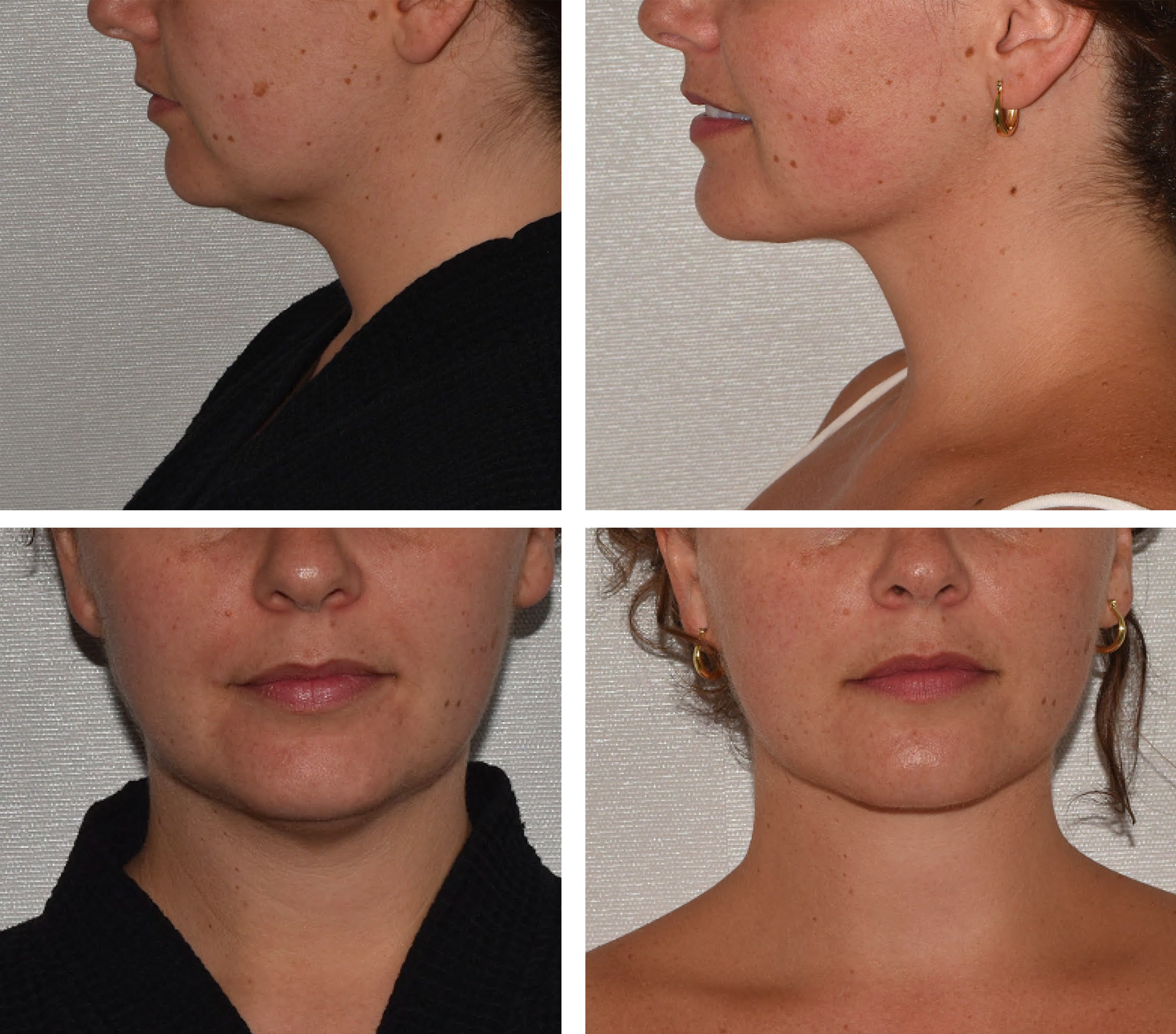 Submental region and jawline before and after VASER-assisted liposuction for fullness beneath the chin.