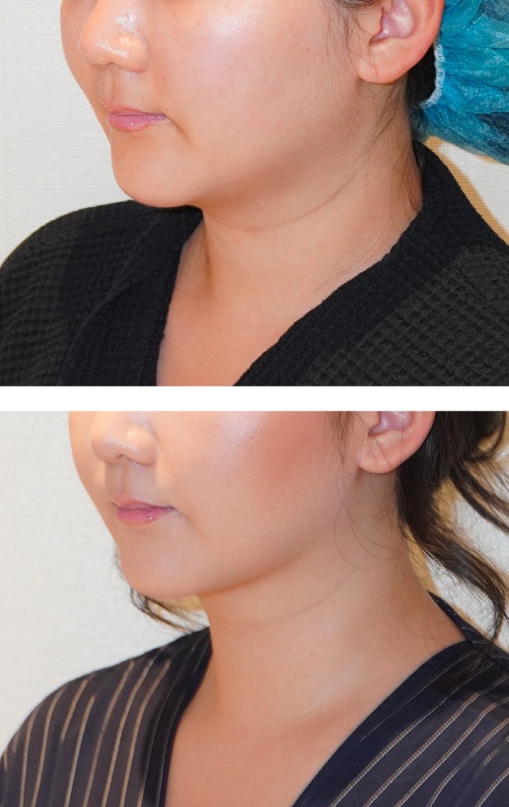 Chin liposuction photographs, b41.
