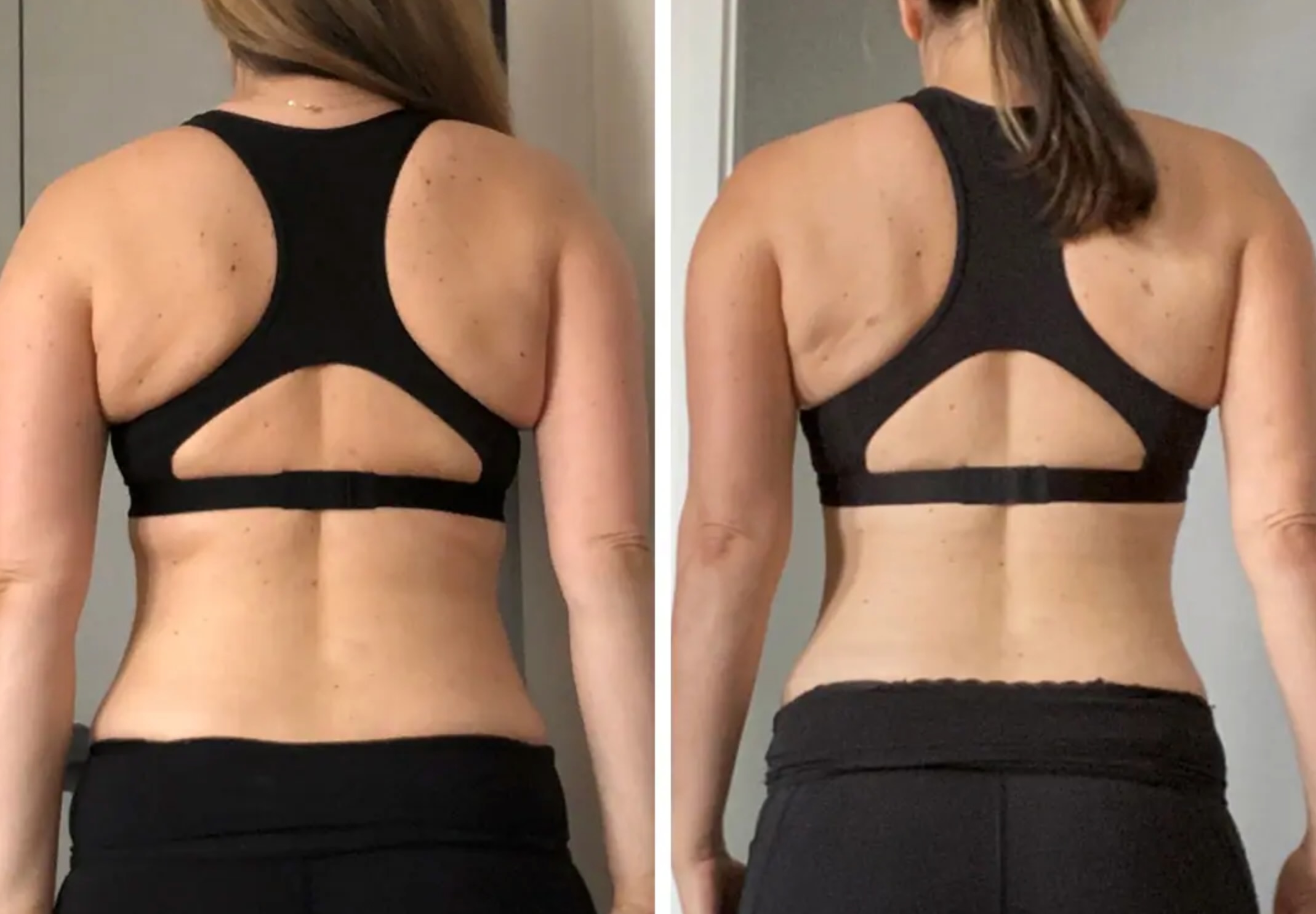 Before and after liposuction with BodyTite of the upper and lower back.