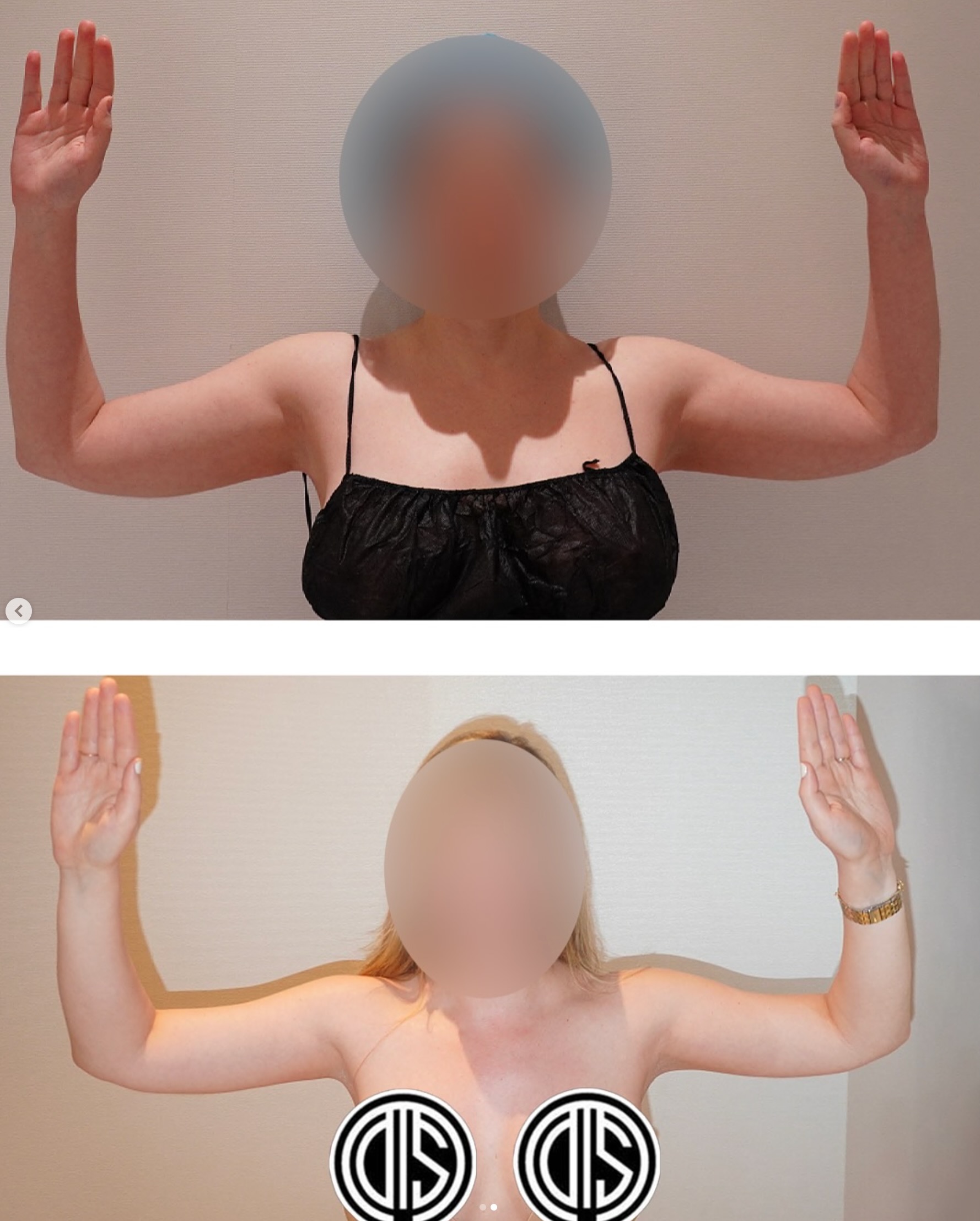 Before and after arm contouring with VASER liposuction and BodyTite; additional view.