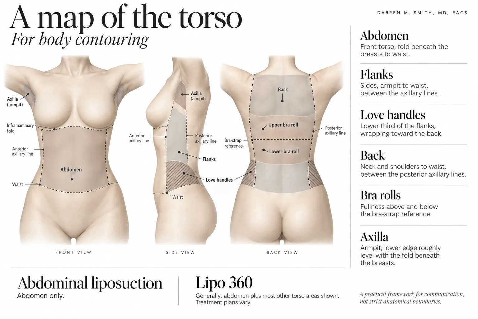 Front, side and back torso illustration identifying the abdomen, flanks, love handles, back, bra rolls and axillae.