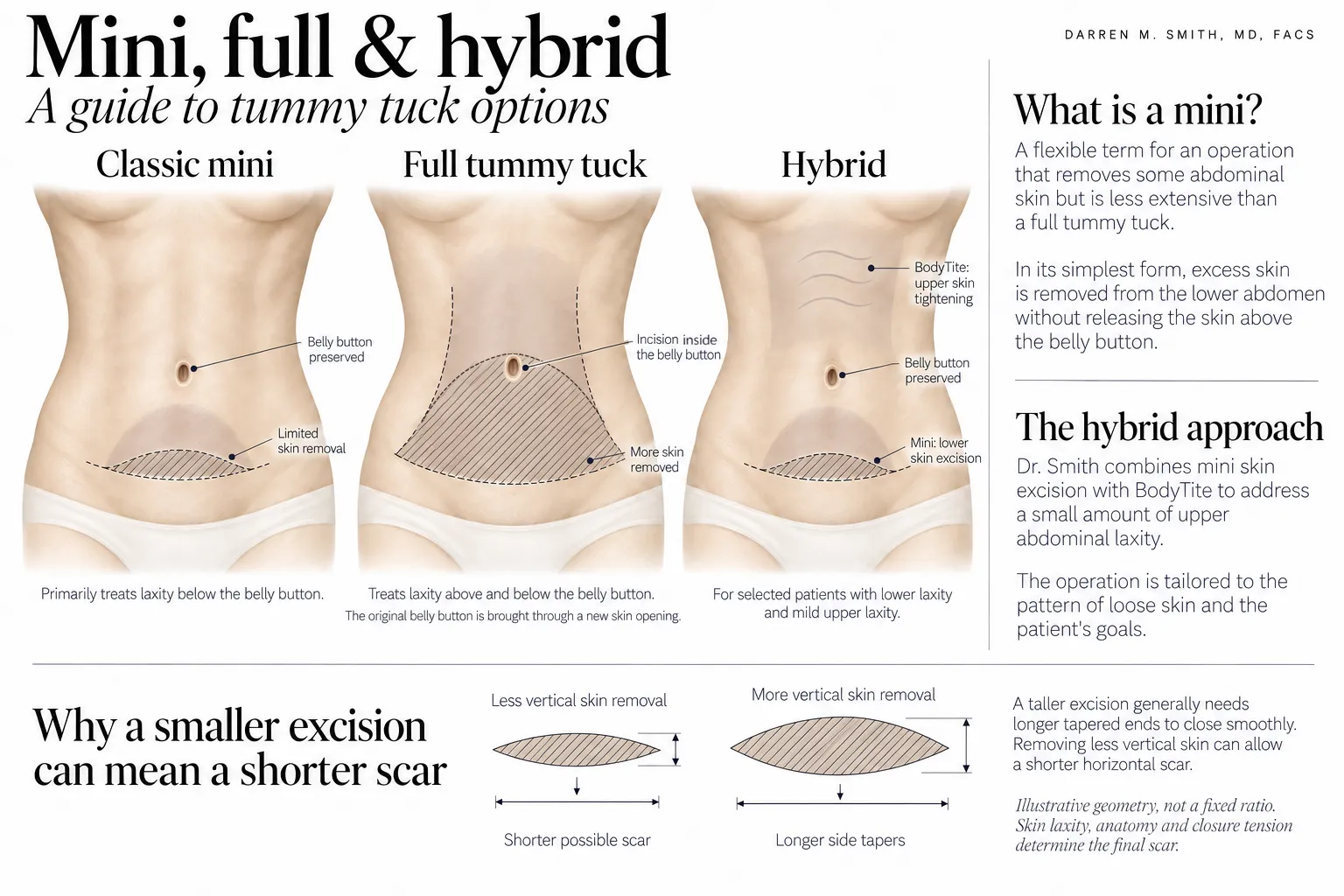 Diagram comparing mini, full and hybrid tummy tucks, including treatment areas, belly button incisions and how skin removal affects scar length.