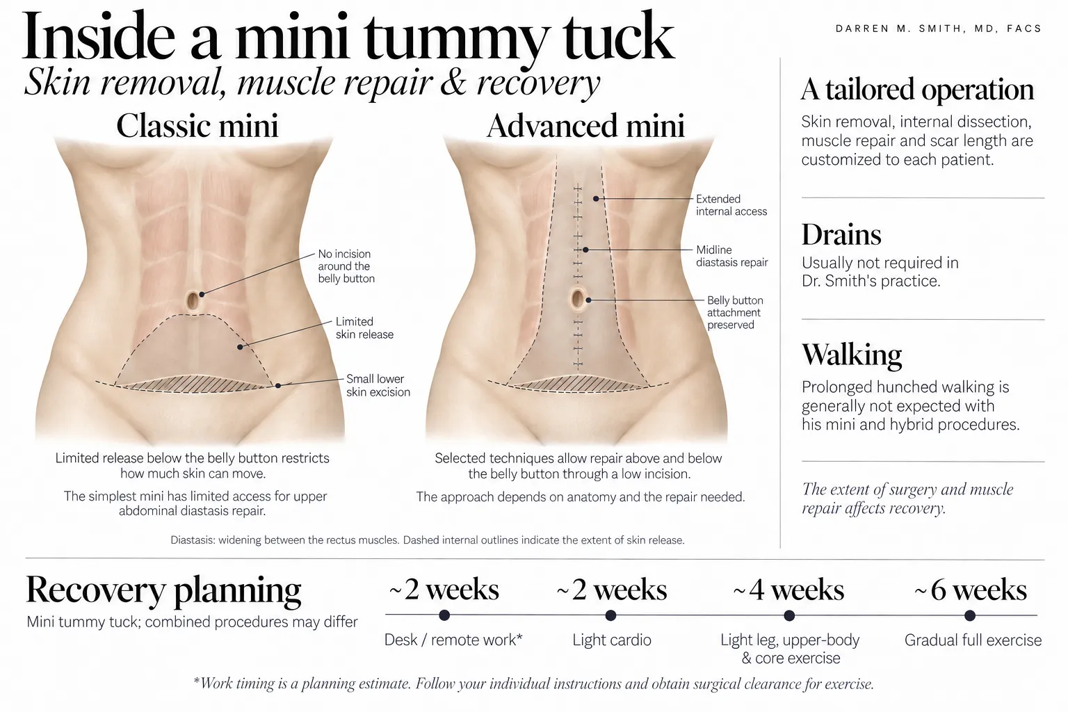 Classic and advanced mini tummy tuck diagrams showing skin release, lower skin removal, diastasis repair and recovery-planning milestones.