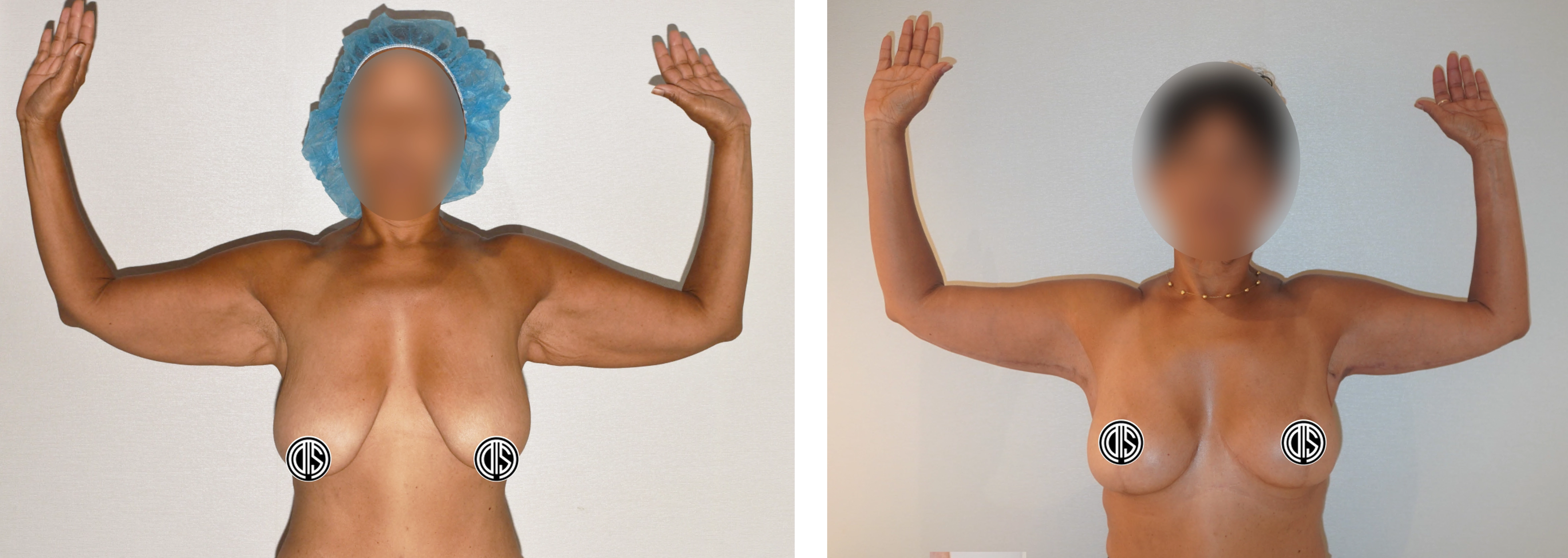 Before and after extended arm lift and breast reduction and lift with auto-augmentation following more than 100 pounds of GLP-1 weight loss.