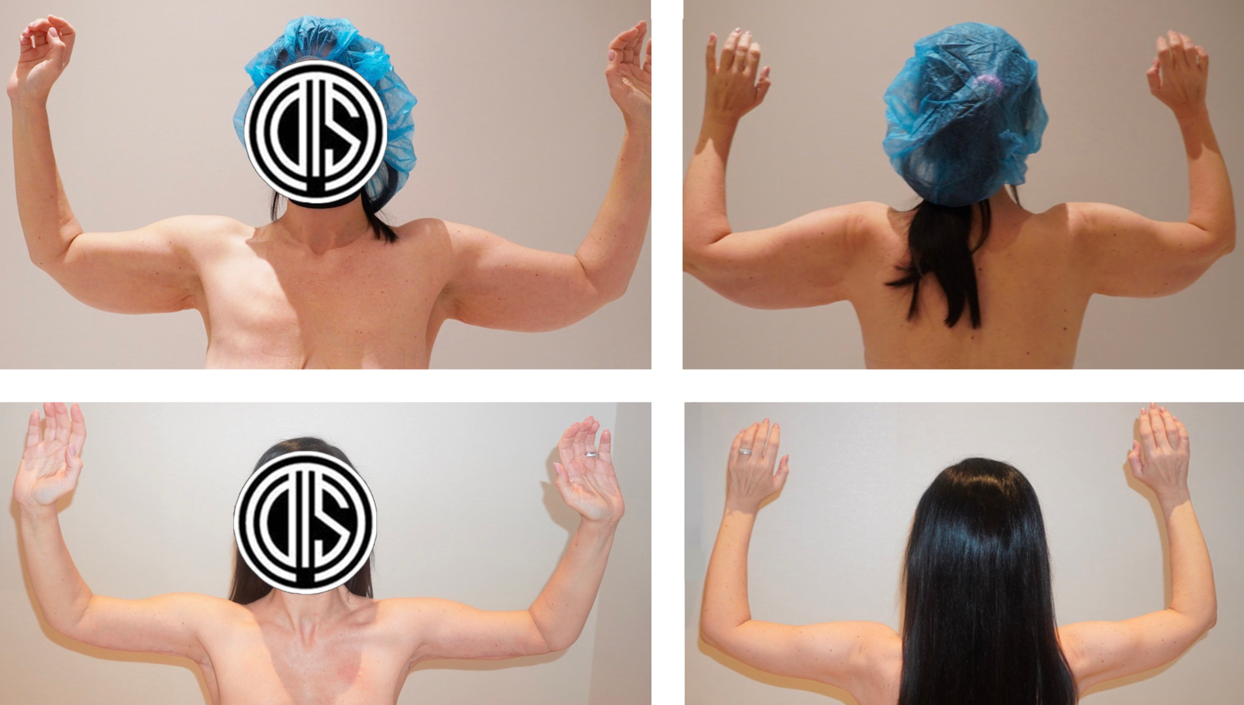 Arm Lift Case 6: before and after arm lift photographs.