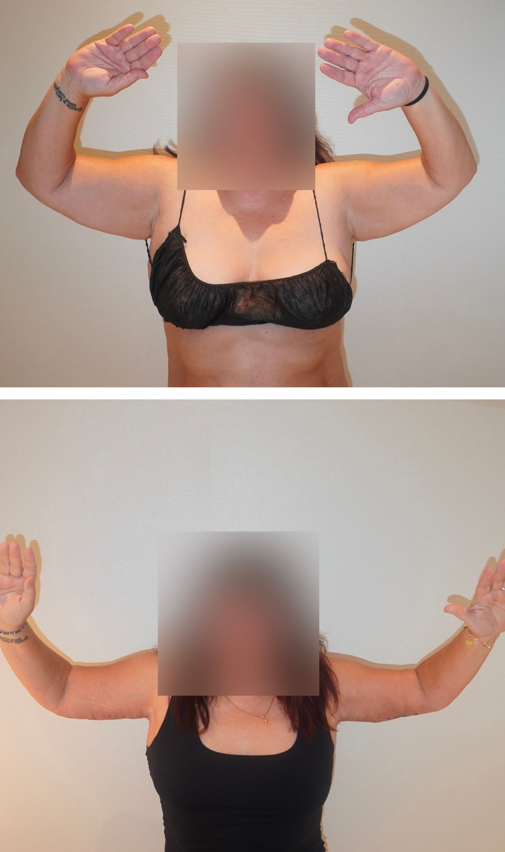 Arm lift before and after photographs, patient 4