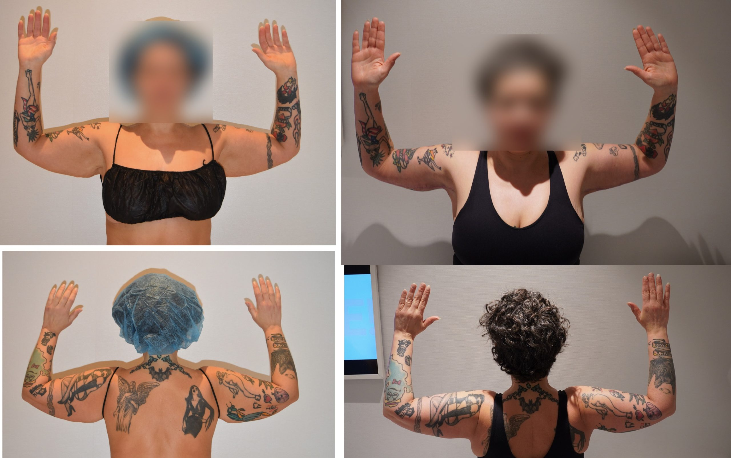 Arm lift before and after photographs, patient 8