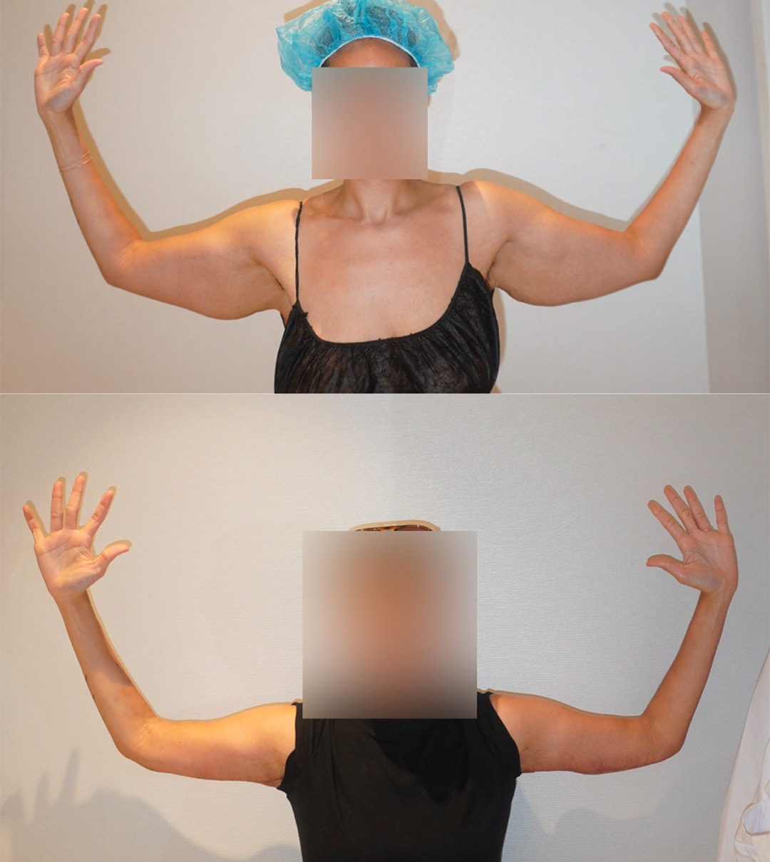 Arm lift before and after photographs, patient 5