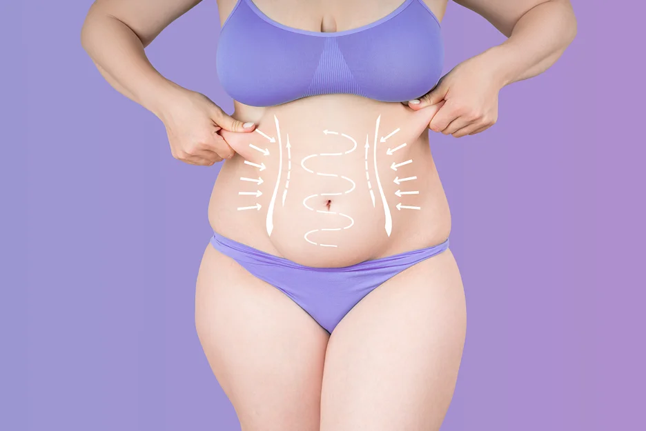 Woman pinching abdominal tissue with body contouring markings illustrated across the abdomen