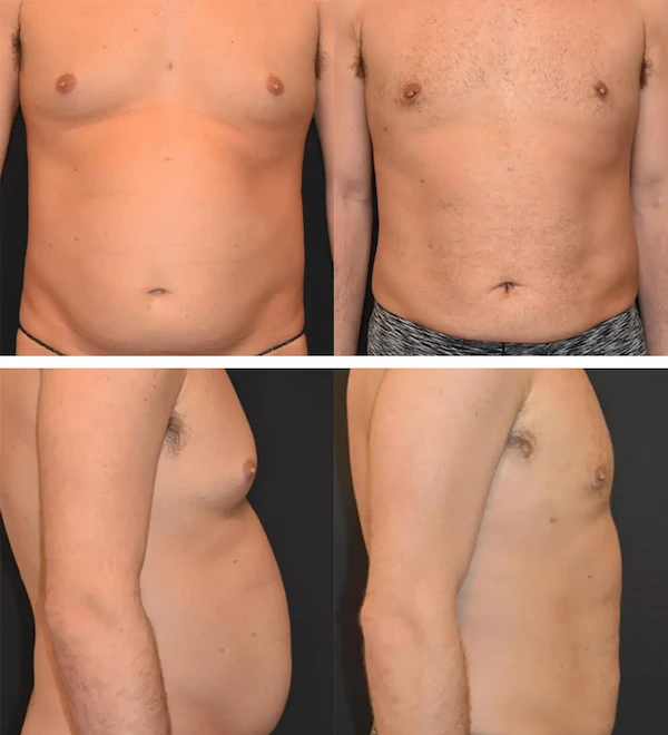 Before and after BodyTite, case 1.