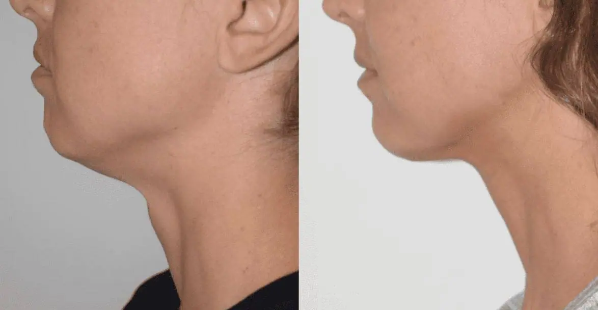 Before and after liposuction, case 4.