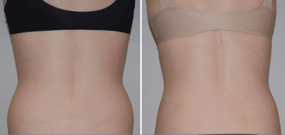 Before and after liposuction, case 6.