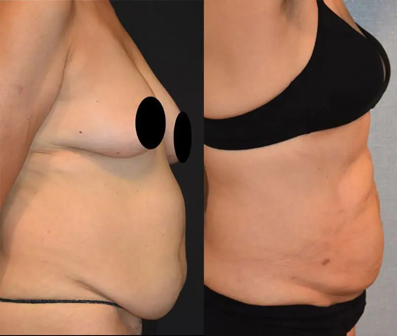 Before and after BodyTite, case 4.