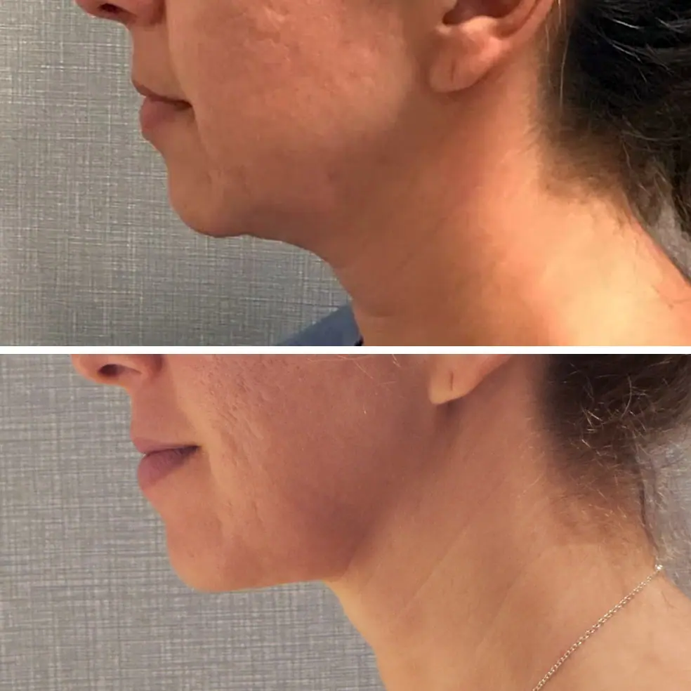 Before and after liposuction, case 26.