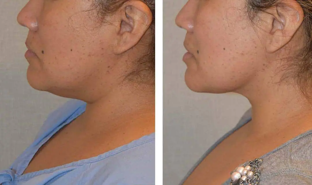 Before and after liposuction, case 23.