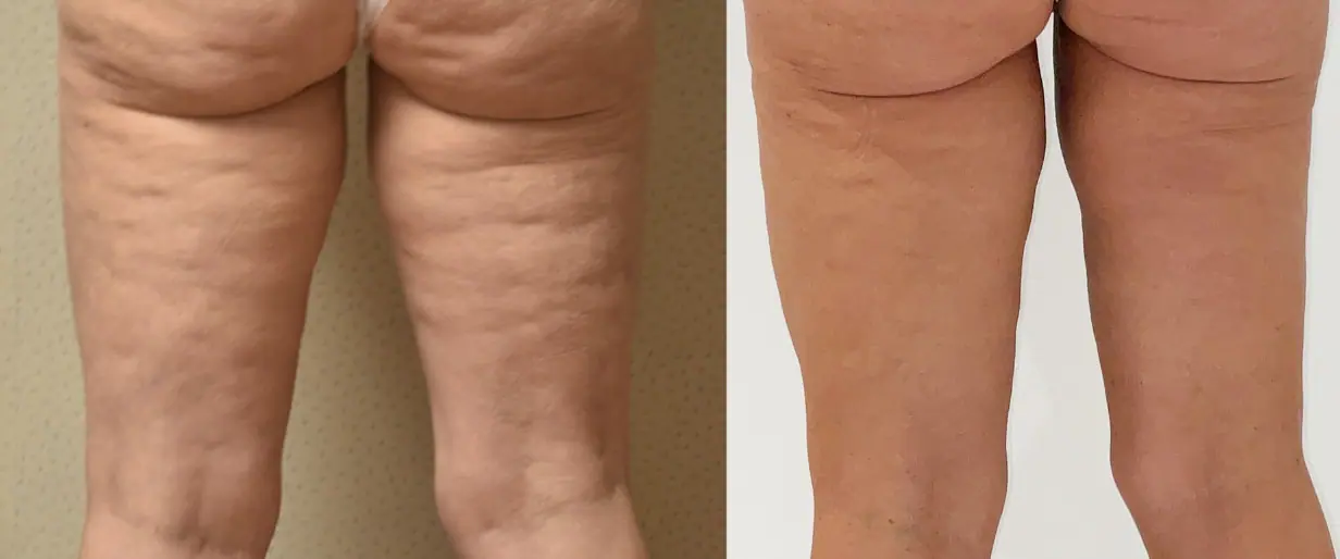Before and after BodyTite, case 9.