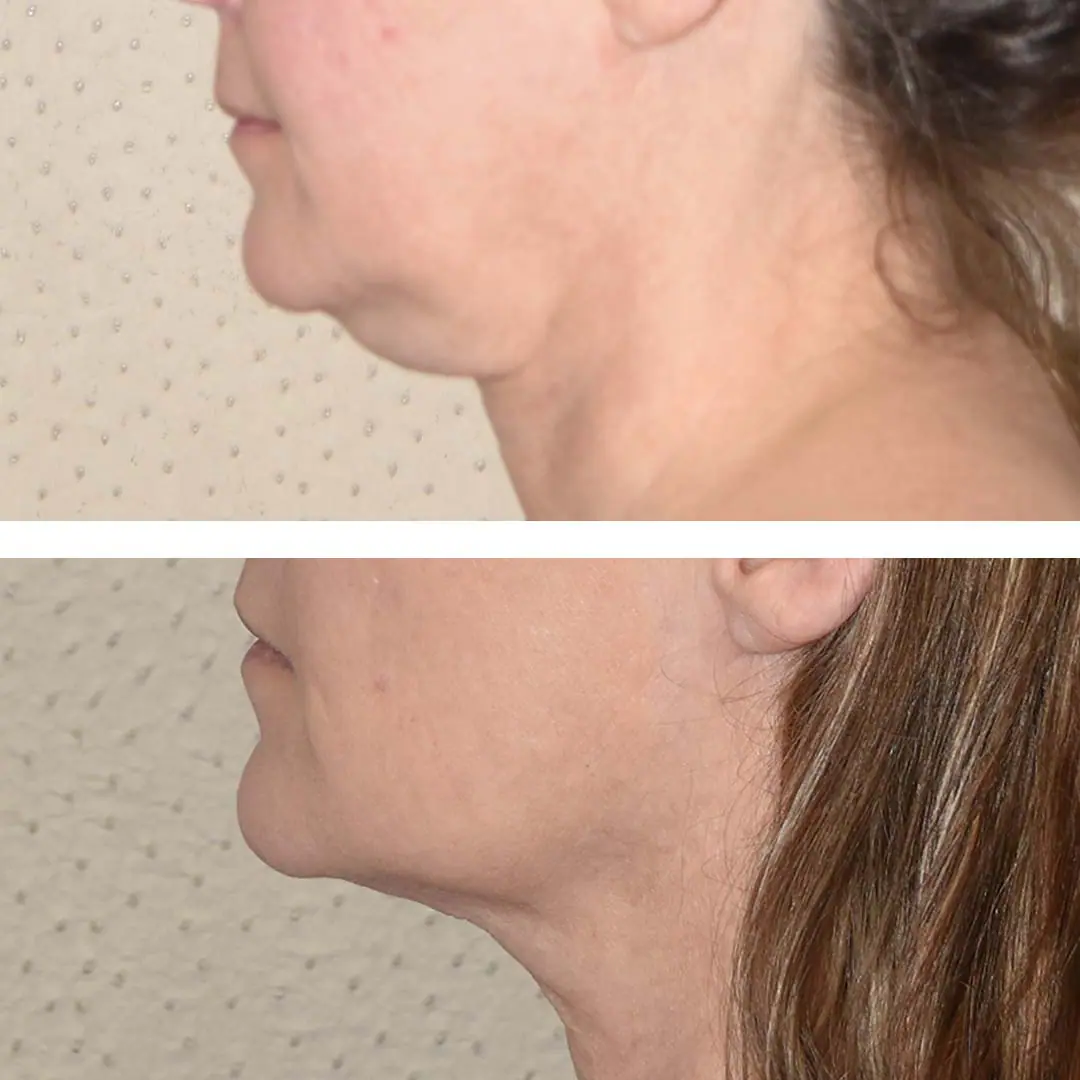 Before and after BodyTite, case 8.
