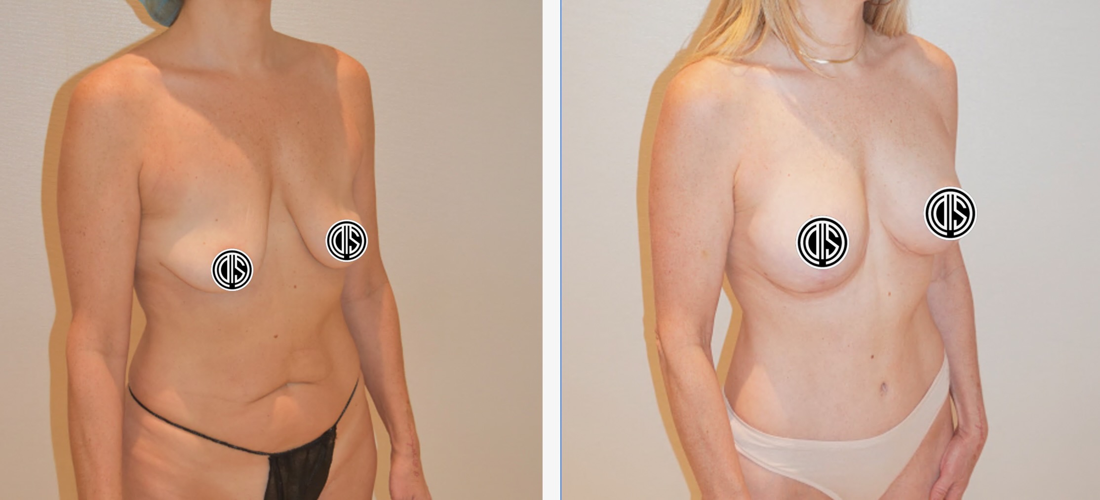 Before and 5 months after a full tummy tuck, breast augmentation and breast lift. This mother in her 50s wanted a lean, natural-looking contour after reaching her fitness goals.