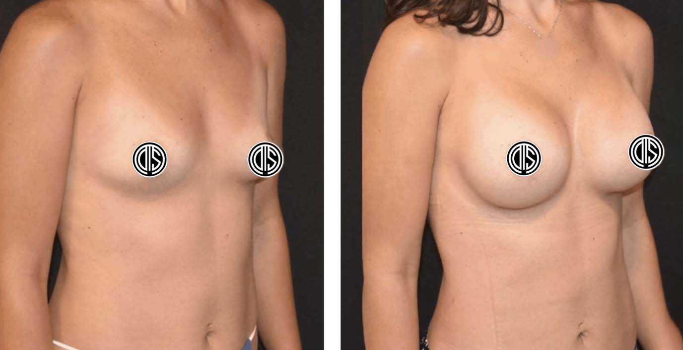 Before and 6 months after breast augmentation and flank liposuction. This patient wanted fuller breasts and a more defined waist after pregnancy; her mommy makeover did not include a tummy tuck.