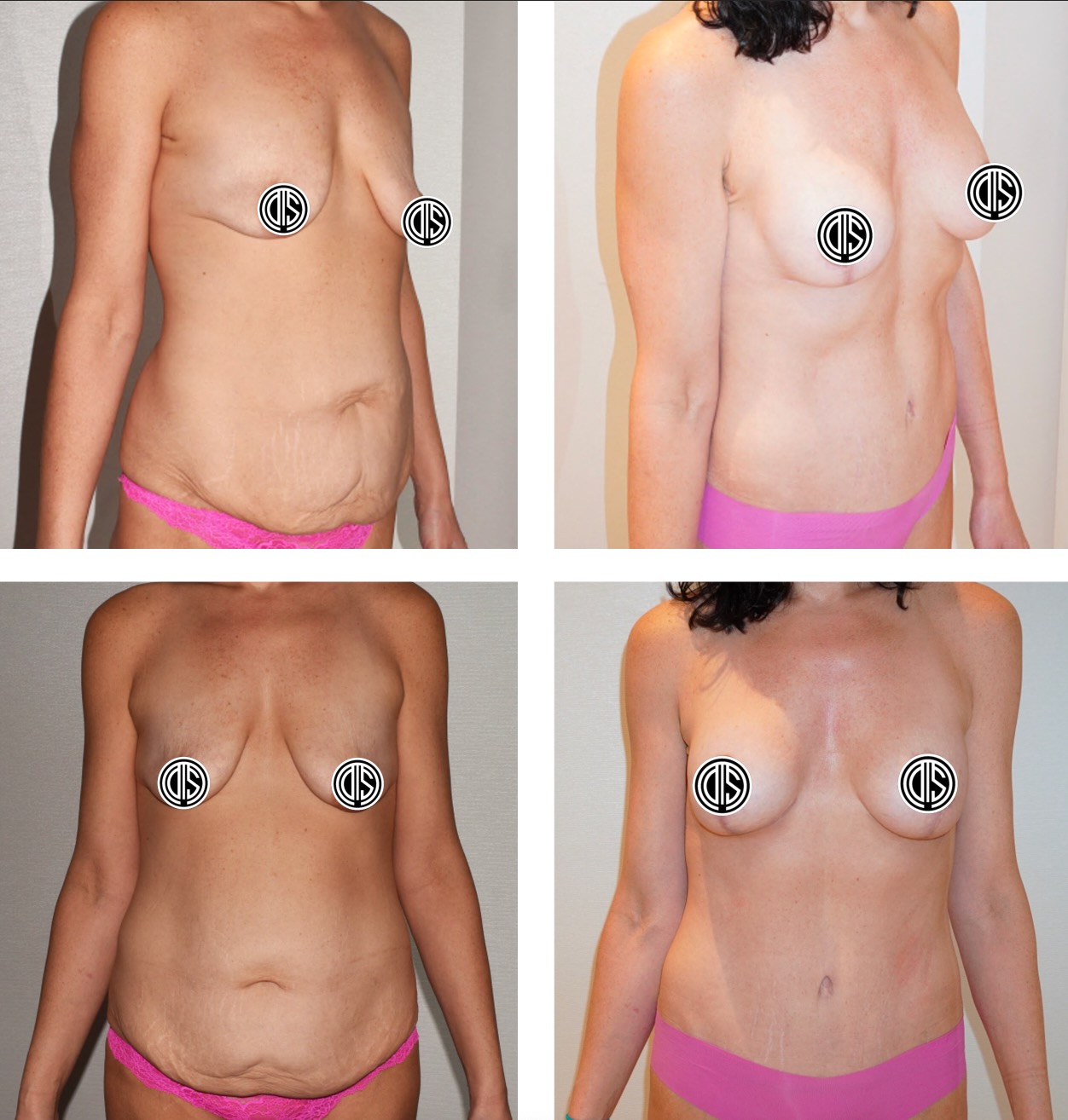 Before and after tummy tuck, case 4.
