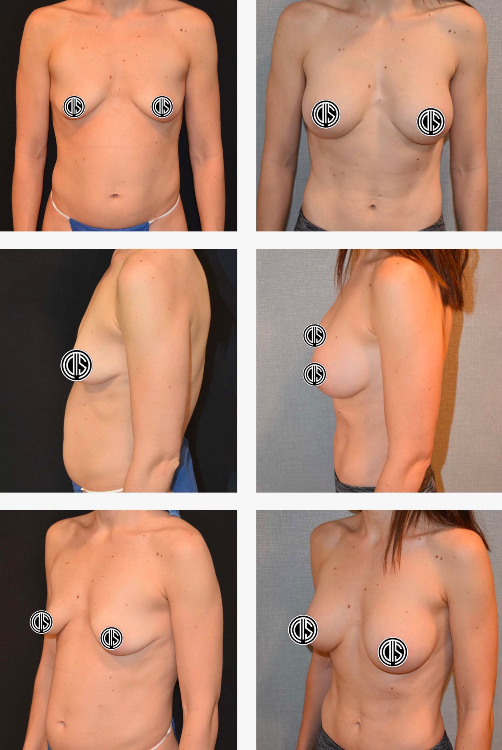 Before and after breast augmentation, case 13.