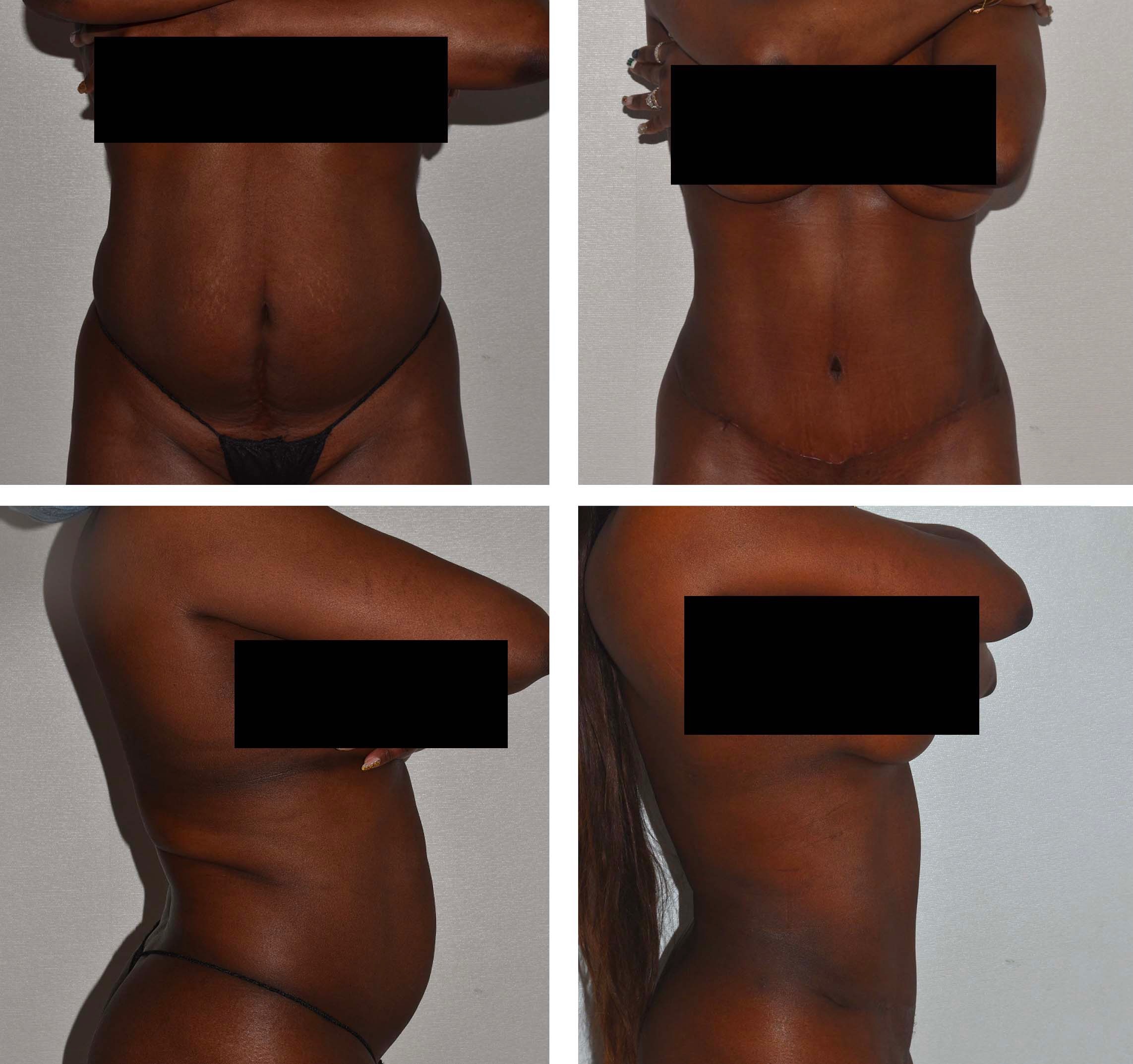 Tummy tuck and Lipo 360 before-and-after photographs of a mother in her 50s. Her goal was to regain a fit, toned appearance after pregnancy through abdominal and waist contouring.