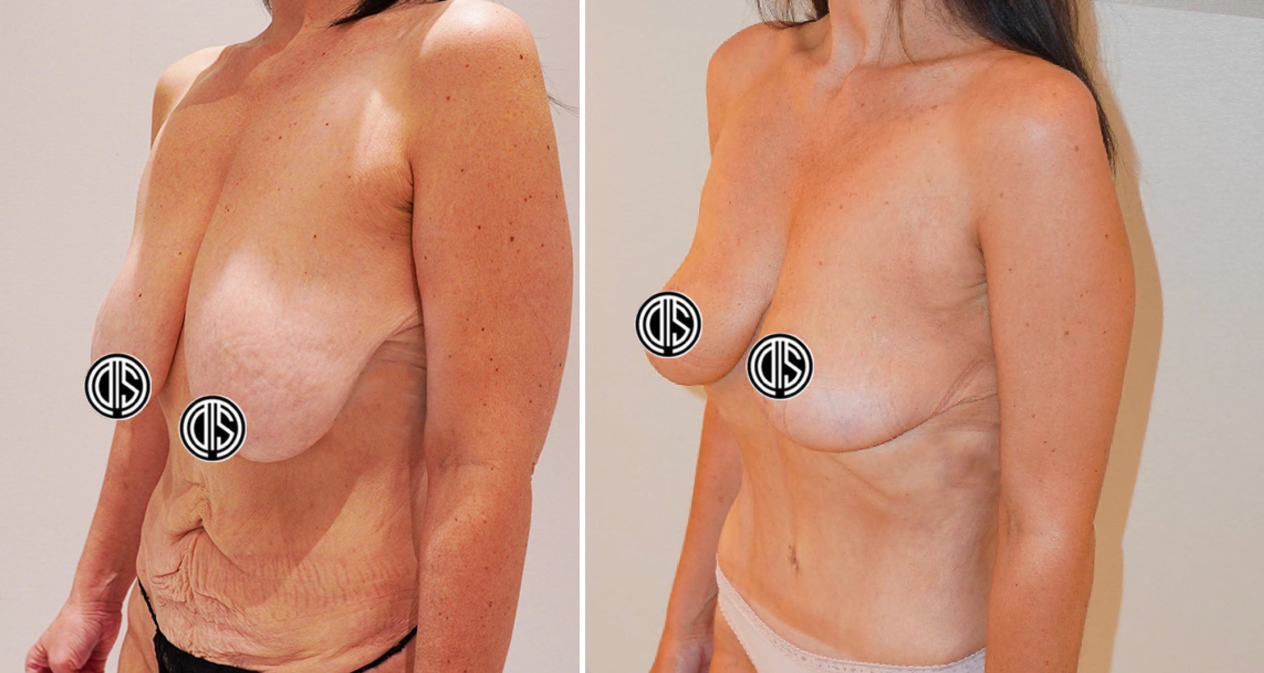 Tummy tuck and breast lift before and after more than 90 pounds of weight loss with Mounjaro. This mother of two preferred a natural breast appearance as part of her body-contouring plan.