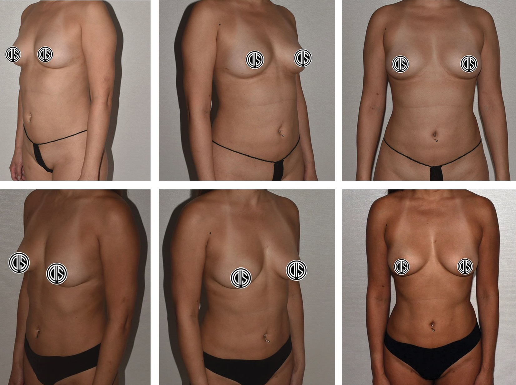 Before and after Lipo 360 and breast fat transfer in a mother in her 30s. Her goals were a more toned core and a modest increase in breast fullness using her own fat.