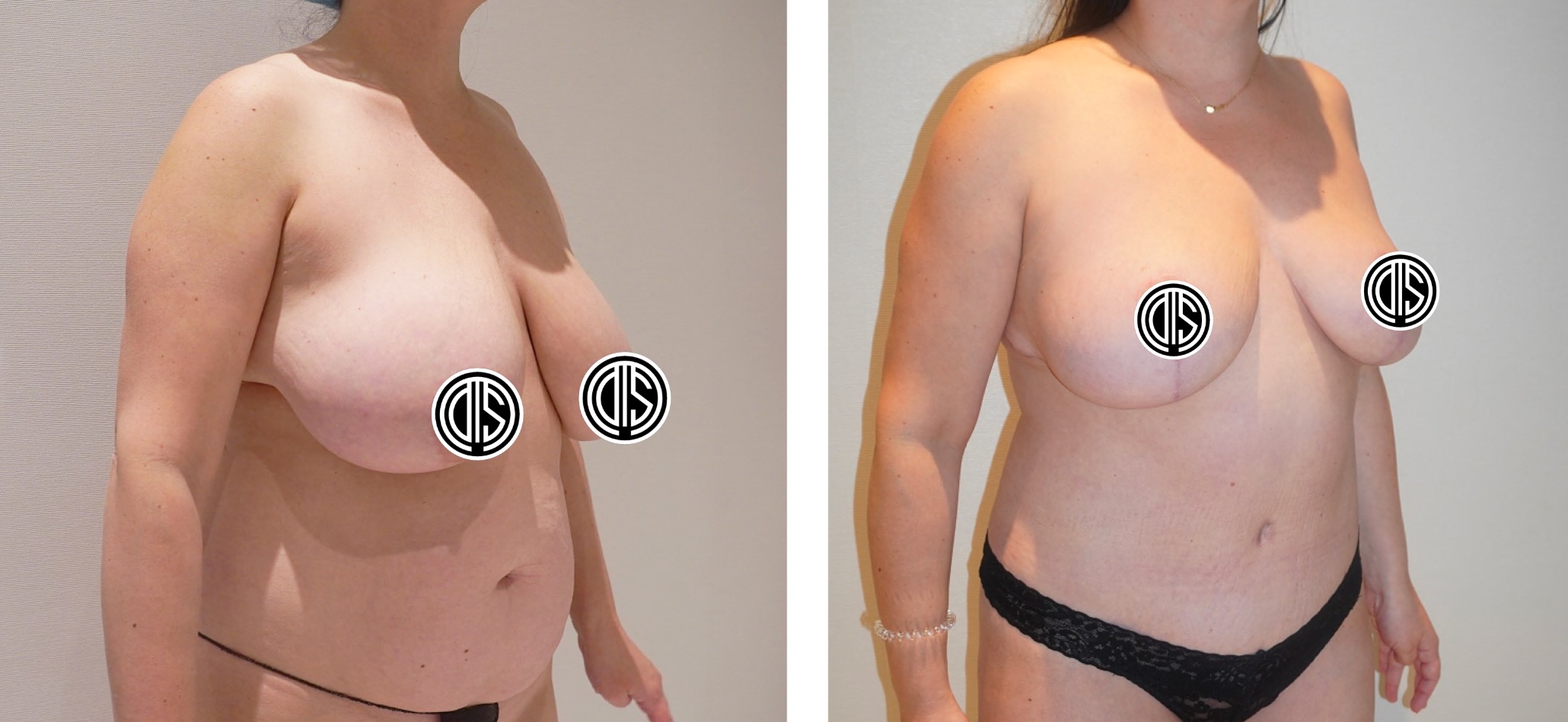 Before and after tummy tuck, case 7.