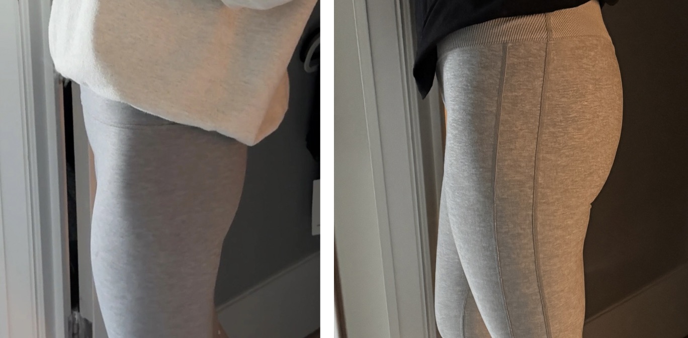 Before and after AlloClae treatment, case 1.