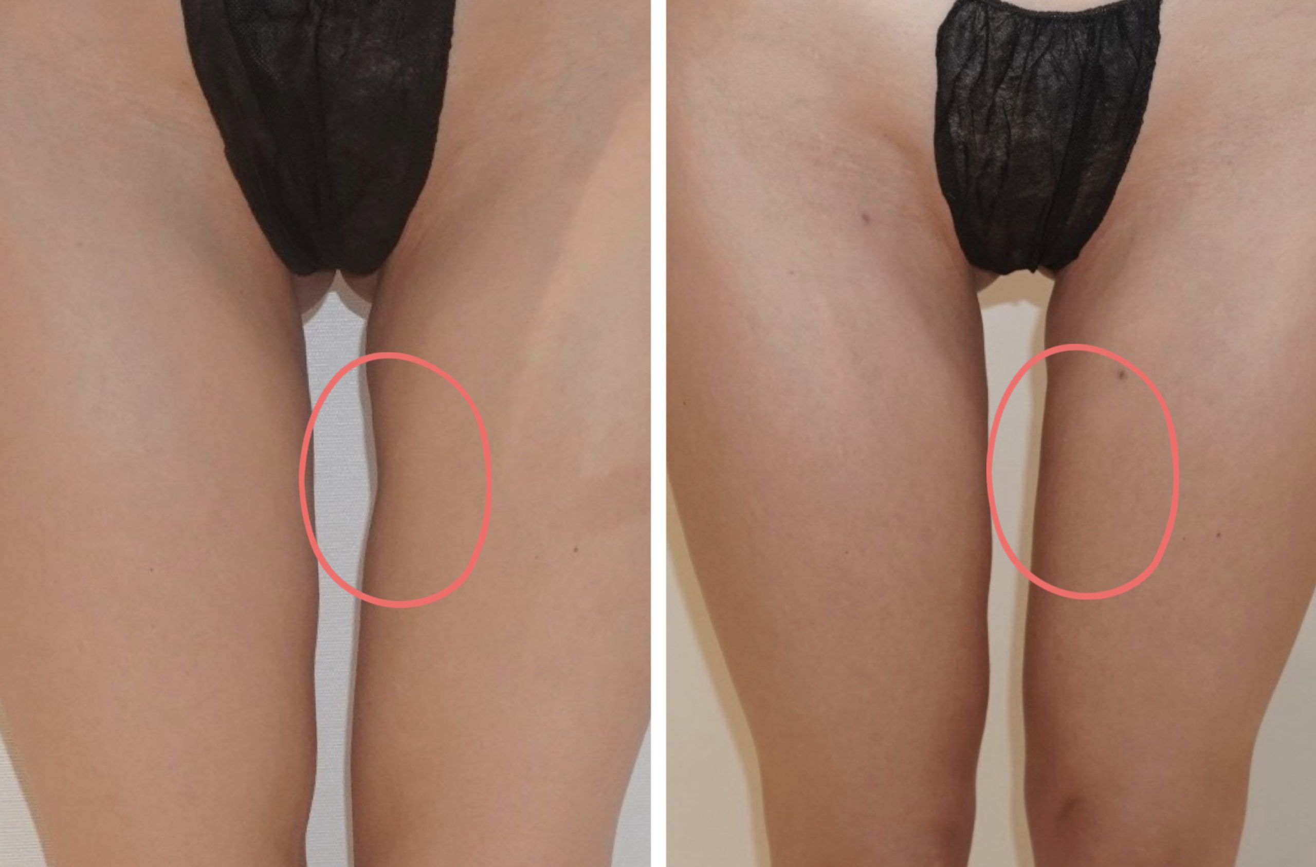 Before and after Alloclae treatment, case 2.