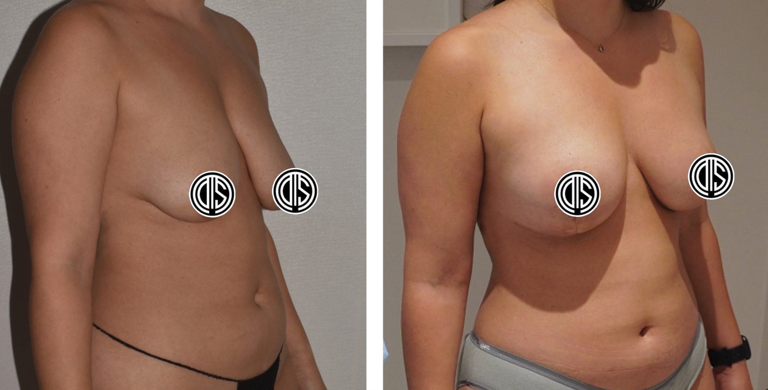 Before and after fat transfer breast augmentation, case 2.