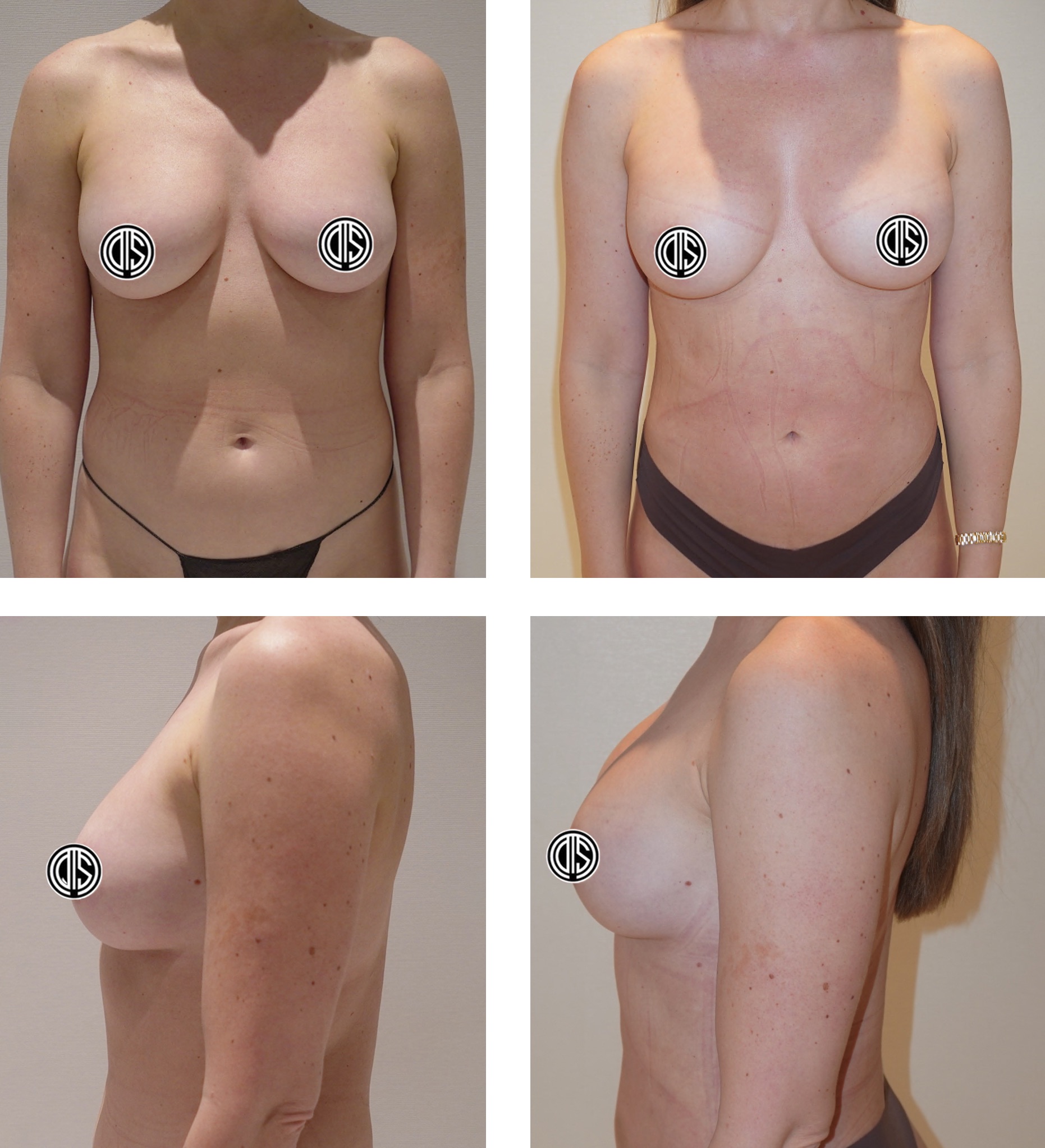 Before and after fat transfer breast augmentation, case 3.
