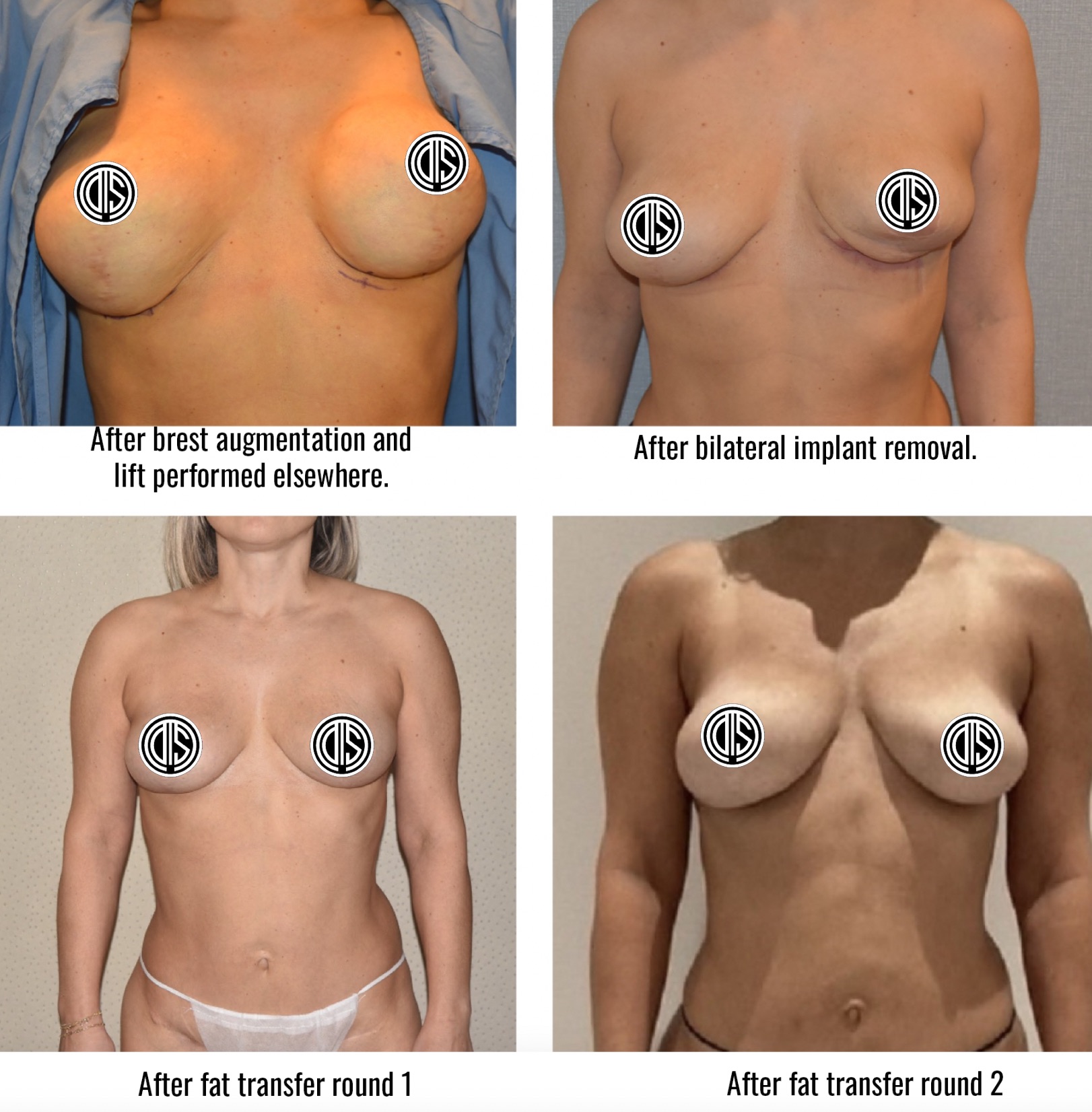 Before and after fat transfer breast augmentation, case 4.